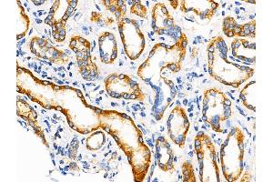 ABIN6258581 and ABIN6274584 at 1/100 staining Human kidney cancer and adjacent normal tissues by IHC-P.