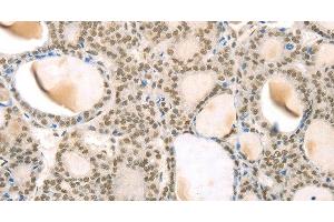 Immunohistochemistry of paraffin-embedded Human thyroid cancer using TSPAN13 Polyclonal Antibody at dilution of 1:35 (TSPAN13 antibody)