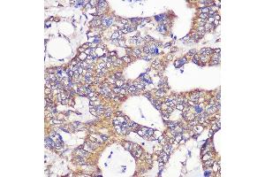Immunohistochemistry of paraffin-embedded Human colon carcinoma using TUBGCP6 Rabbit pAb (ABIN7271055) at dilution of 1:100 (40x lens). (GCP6 antibody  (AA 600-900))