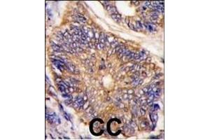 Formalin-fixed and paraffin-embedded human colon carcinoma tissue reacted with LDLR antibody (N-term) (ABIN392553 and ABIN2842100) , which was peroxidase-conjugated to the secondary antibody, followed by DAB staining. (LDLRAP1 antibody  (N-Term))