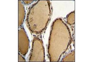 Immunohistochemistry analysis in formalin fixed and paraffin embedded human thyroid tissue reacted with CCDC128 Antibody (Center) followed by peroxidase conjugation of the secondary antibody and DAB staining. (KLRAQ1 antibody  (Middle Region))