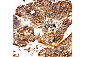 Anti-Calbindin Picoband antibody,  IHC(P): Human Intestinal Cancer Tissue (CALB1 antibody  (AA 2-175))