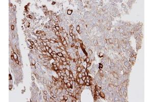 IHC-P Image Immunohistochemical analysis of paraffin-embedded D54MG xenograft, using KRT6A, antibody at 1:100 dilution. (KRT6A antibody)
