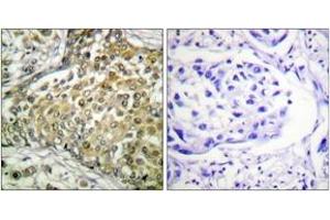 Immunohistochemistry analysis of paraffin-embedded human lung carcinoma tissue, using p53 (Acetyl-Lys379) Antibody.