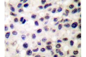 Immunohistochemistry analyzes of Stat5b antibody in paraffin-embedded human colon carcinoma tissue. (STAT5B antibody)
