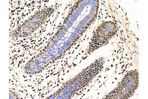 ABIN7094843 and ABIN7098894 at 1/100 staining Human esophageal cancer by IHC-P.