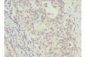 Immunohistochemistry of paraffin-embedded human bladder cancer using ABIN7144072 at dilution of 1:100 (ANAPC2 antibody  (AA 1-230))