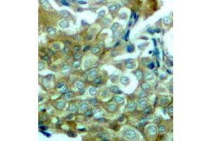 Immunohistochemistry (IHC) image for anti-Epidermal Growth Factor Receptor (EGFR) (pTyr1172) antibody (ABIN3019839) (EGFR antibody  (pTyr1172))