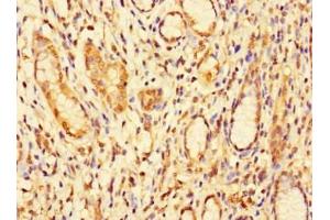 Immunohistochemistry of paraffin-embedded human gastric cancer using ABIN7157917 at dilution of 1:100 (DBR1 antibody  (AA 1-220))