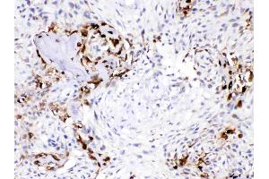 CA3 was detected in paraffin-embedded sections of human osteosarcoma tissues using rabbit anti- CA3 Antigen Affinity purified polyclonal antibody (Catalog # ) at 1 µg/mL. (CA3 antibody  (AA 14-235))