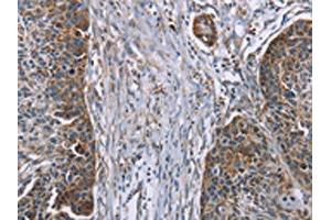 The image on the left is immunohistochemistry of paraffin-embedded Human esophagus cancer tissue using ABIN7191114(IQCJ Antibody) at dilution 1/30, on the right is treated with synthetic peptide. (IQCJ antibody)