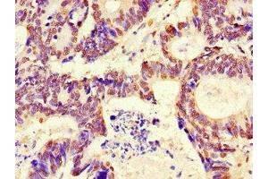 Immunohistochemistry of paraffin-embedded human colon cancer using ABIN7167735 at dilution of 1:100 (RFPL4B antibody  (AA 1-263))