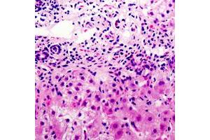 Immunohistochemical analysis of Cystatin E/M staining in human liver cancer formalin fixed paraffin embedded tissue section.