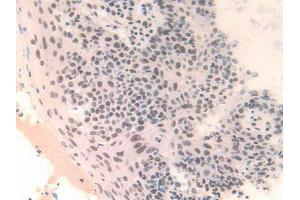 IHC-P analysis of Human Skin Cancer Tissue, with DAB staining. (FAM19A3 antibody  (AA 44-130))