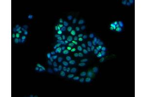Immunofluorescent staining of human colorectal adenocarcinoma (CDX2 antibody)