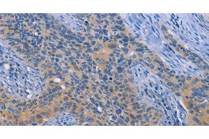 Immunohistochemistry of paraffin-embedded Human cervical cancer tissue using NEK8 Polyclonal Antibody at dilution 1:30 (NEK8 antibody)