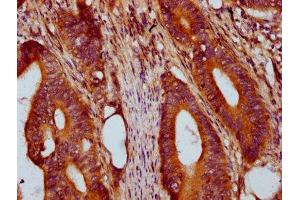 IHC image of ABIN7172139 diluted at 1:400 and staining in paraffin-embedded human colon cancer performed on a Leica BondTM system. (PRSS16 antibody  (AA 352-489))