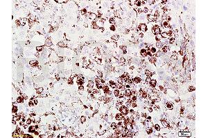 Formalin-fixed and paraffin embedded mouse melanoma labeled with Anti-Melanoma HMB45/Melanoma/Melan-A/MART-1 Polyclonal Antibody, Unconjugated (ABIN724190) at 1:200 followed by conjugation to the secondary antibody and DAB staining.