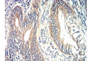 Immunohistochemical analysis of paraffin-embedded rectum cancer tissues using TIA1 mouse mAb with DAB staining. (TIA1 antibody  (AA 1-215))