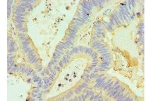 Immunohistochemistry of paraffin-embedded human colon cancer using ABIN7154304 at dilution of 1:100 (GORASP1 antibody  (AA 221-440))