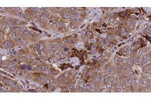 ABIN6273843 at 1/100 staining Human liver cancer tissue by IHC-P. (DRD5 antibody  (N-Term))
