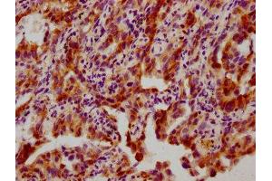 IHC image of ABIN7127701 diluted at 1:100 and staining in paraffin-embedded human lung cancer performed on a Leica BondTM system. (Recombinant HSP27 antibody  (pSer82))