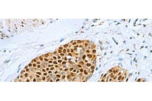 Immunohistochemistry of paraffin-embedded Human esophagus cancer tissue using TFAP4 Polyclonal Antibody at dilution of 1:70(x200) (TFAP4 antibody)