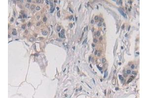 Detection of STX2 in Human Breast cancer Tissue using Polyclonal Antibody to Syntaxin 2 (STX2) (STX2 antibody  (AA 8-262))