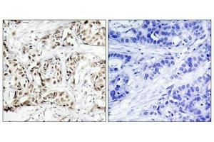 Immunohistochemical analysis of paraffin-embedded human breast carcinoma tissue using SAPK/JNK(Phospho-Thr183) Antibody(left) or the same antibody preincubated with blocking peptide(right). (MAPK9/MAPK1 (pThr183) antibody)