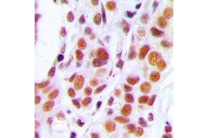 Immunohistochemical analysis of RB1 staining in human stomach cancer formalin fixed paraffin embedded tissue section. (Retinoblastoma 1 antibody  (C-Term))