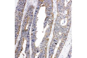 Anti-Eph receptor A1 antibody, IHC(P) IHC(P): Human Colon Cancer Tissue (EPHA1 antibody  (C-Term))