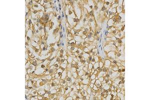 Immunohistochemistry of paraffin-embedded human kidney cancer using ADRBK2 antibody at dilution of 1:200 (x400 lens) (ADRBK2 antibody  (AA 1-300))