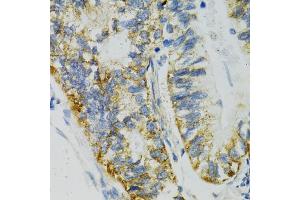 Immunohistochemistry of paraffin-embedded human gastric cancer using SLC27A2 antibody (ABIN5970435) at dilution of 1/100 (40x lens). (SLC27A2 antibody)