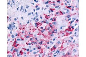 Anti-RXFP2 / LGR8 antibody IHC of human Brain, Glioblastoma. (RXFP2 antibody  (Extracellular Domain))
