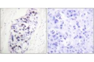 Immunohistochemistry analysis of paraffin-embedded human lung carcinoma tissue, using HDAC1 Antibody. (HDAC1 antibody  (AA 433-482))