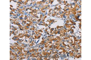 Immunohistochemistry of Human liver cancer using TSPEAR Polyclonal Antibody at dilution of 1:50 (TSPEAR antibody)