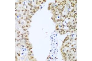 Immunohistochemistry of paraffin-embedded human lung cancer using HDAC1 antibody.