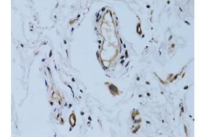 Immunohistochemistry of paraffin-embedded human colon carcinoma using MCAM antibody.