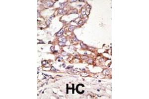 Formalin-fixed and paraffin-embedded human hepatocellular carcinoma tissue reacted with the SUMO4 polyclonal antibody  , which was peroxidase-conjugated to the secondary antibody, followed by AEC staining. (SUMO4 antibody  (Internal Region))