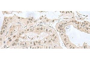 Immunohistochemistry of paraffin-embedded Human thyroid cancer tissue using PCBD1 Polyclonal Antibody at dilution of 1:60(x200) (PCBD1 antibody)