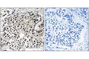 Immunohistochemistry analysis of paraffin-embedded human breast carcinoma tissue, using PECI Antibody. (PECI/ECI2 antibody  (AA 73-122))