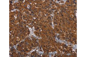 Immunohistochemistry of Human renal cancer using HYAL2 Polyclonal Antibody at dilution of 1:60