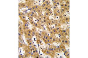 Formalin-fixed and paraffin-embedded human hepatocarcinoma tissue reacted with Phospho-PDX1-T11. (PDX1 antibody  (AA 1-30))