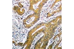 Immunohistochemical analysis of p53 staining in human colon cancer formalin fixed paraffin embedded tissue section.