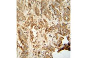 Immunohistochemistry analysis in formalin fixed and paraffin embedded human hepatocarcinoma reacted with NAT14 Antibody (N-term) followed which was peroxidase conjugated to the secondary antibody and followed by DAB staining.