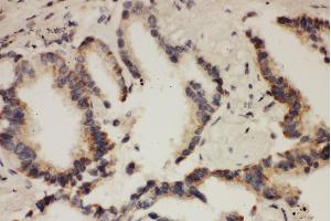 Anti- CUL1antibody, IHC(P) IHC(P): Human Lung Cancer Tissue (Cullin 1 antibody  (N-Term))