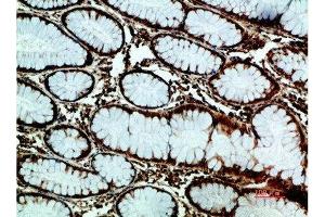Immunohistochemical analysis of paraffin-embedded human-colon-cancer, antibody was diluted at 1:200 (GRP78 antibody  (AA 1268-1341))
