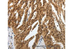 Immunohistochemistry of Human lung cancer using SUMO1 Polyclonal Antibody at dilution of 1:30 (SUMO1 antibody)