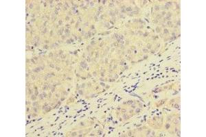 Immunohistochemistry of paraffin-embedded human liver cancer using ABIN7162979 at dilution of 1:100 (PEX16 antibody  (AA 132-336))