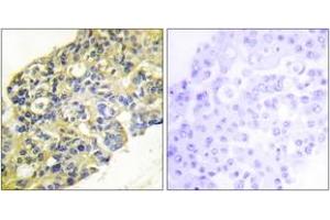 Immunohistochemistry analysis of paraffin-embedded human breast carcinoma tissue, using PI3-kinase p85-alpha/gamma (Ab-467/199) Antibody.